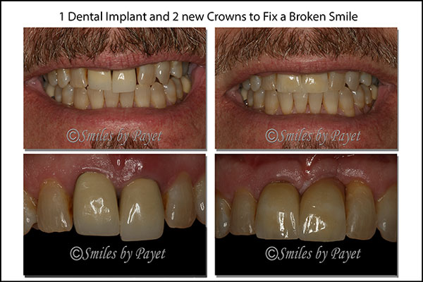 dental implants charlotte nc