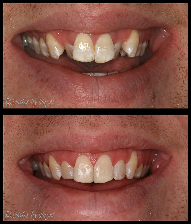Crowded front teeth straightened with Six (6) Month Braces