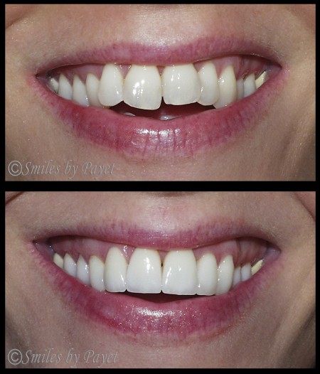 "Instant Braces" - Crowded teeth made straight in only 3 weeks with 20 Porcelain Veneers by Charlotte cosmetic dentist Dr. Charles Payet