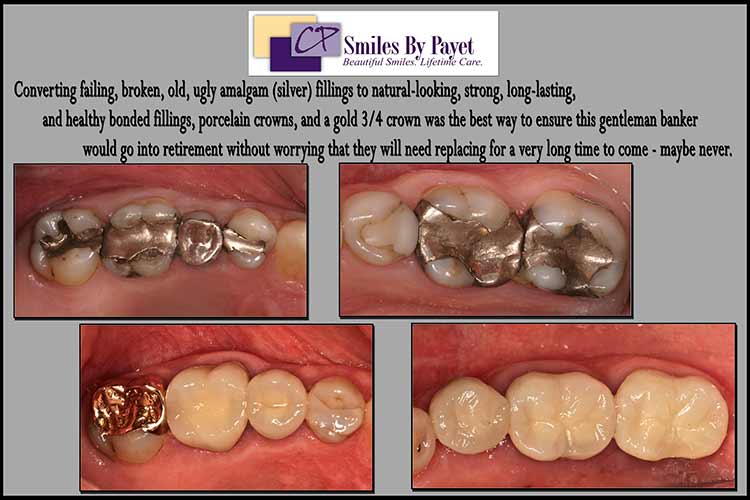 Broken silver fillings with cavities, fixed with porcelain dental crowns, a gold dental crown
