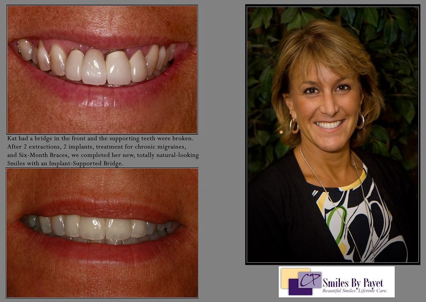 dental implants charlotte nc