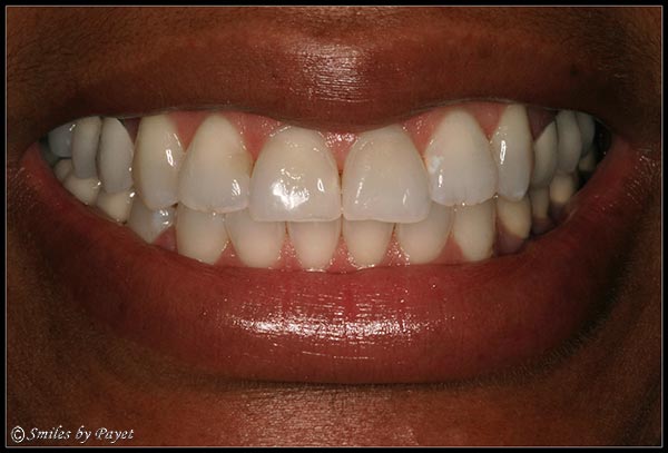 Fixing a Gummy Smile with a Gum Lift, or periodontal plastic surgery - AFTER