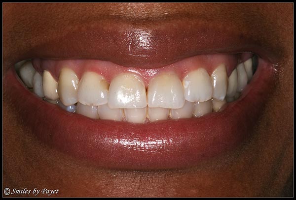 Fixing a Gummy Smile with a Gum Lift, or periodontal plastic surgery - Before