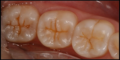 Teeth after small cavities were cleaned out with very small preps, possible because of the dental microscope.