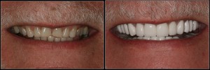Smile makeover charlotte cosmetic dentistry