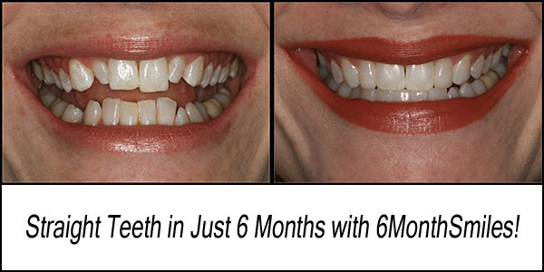 Six Month Adult Braces are almost invisible, work faster, and are more affordable than Invisalign.