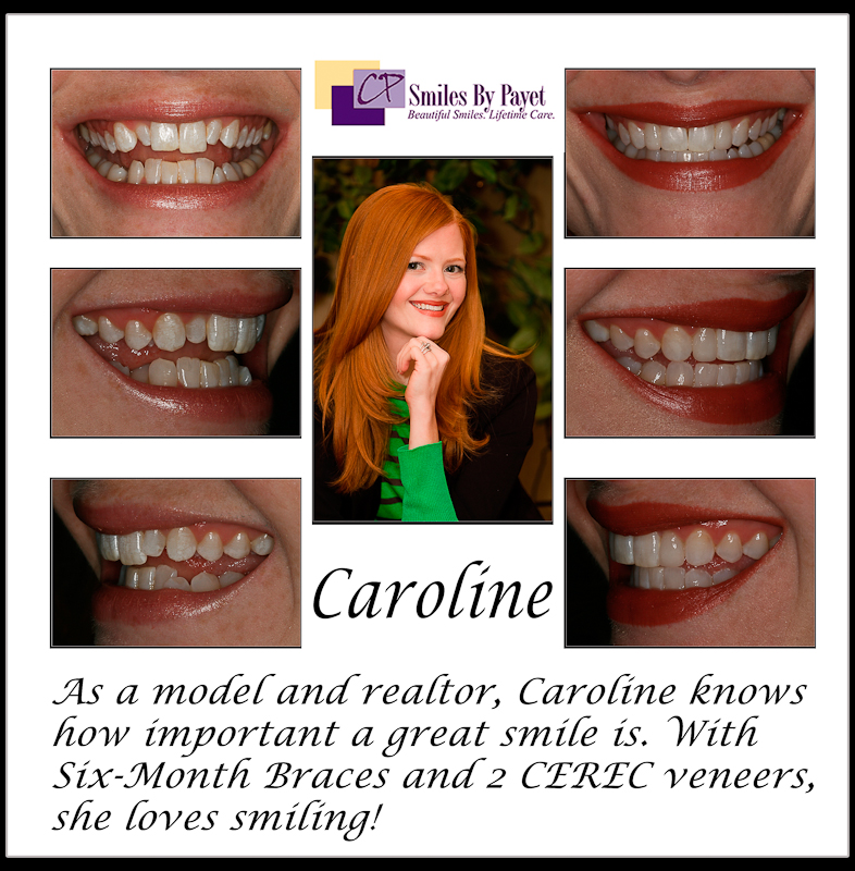 Dr. Payet, a dentist in Charlotte NC, used Six (6) Month Braces and Porcelain CEREC veneers for this smile makeover.