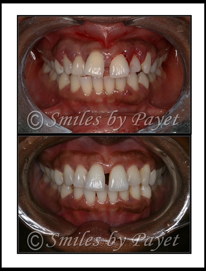 before-after photo of teeth saved by LANAP