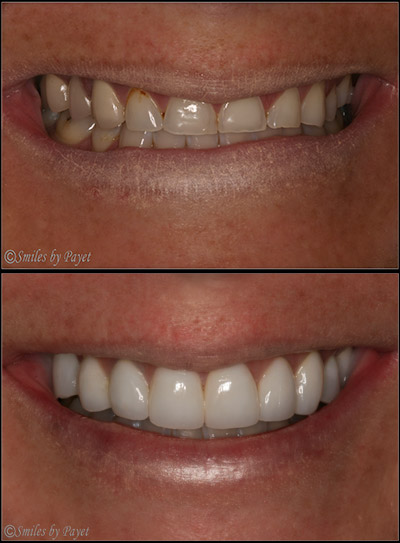 This patient suffered from bulimia, which damaged her teeth; she needed porcelain crowns and dental implants to rebuild her smile.
