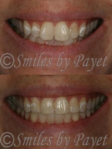 Clear Adult Orthodontics