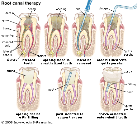 Pictures showing how a dental root canal is done.
