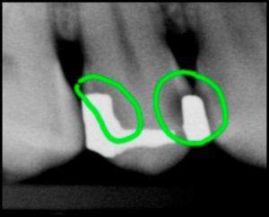 Dental x-ray showing a cavity under an old silver amalgam filling