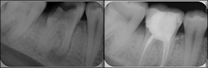 Root canal therapy and porcelain crown done in 1 dental visit by Charlotte dentist Dr. Payet