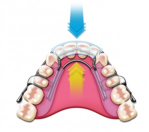 Charlotte dentist Dr. Payet is a Certified Inman Aligner provider