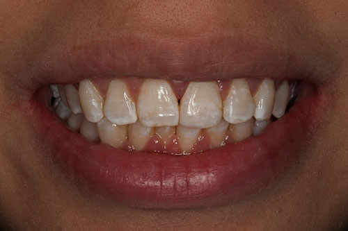 After photo of a smile with composite bonding to fix a broken tooth