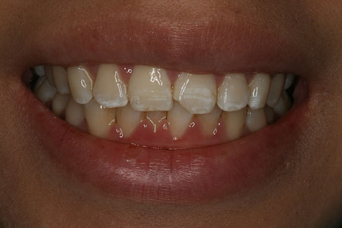 chipped front tooth before