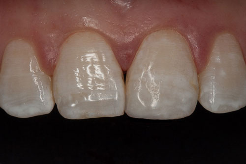 Close-up photo of a tooth-colored composite filling, or bonding