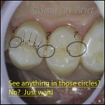 Teeth with cavities don't always have holes in them.