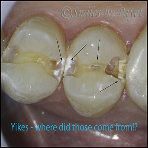 See what tooth cavities look like on the inside