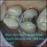 Dentists use blue dyes and dental microscopes to see how much tooth decay to remove