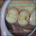 After cavities are cleaned out, there can be big holes to fill.