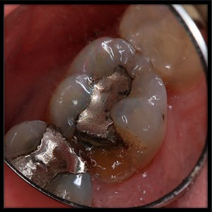 A broken tooth with an old mercury silver filling.