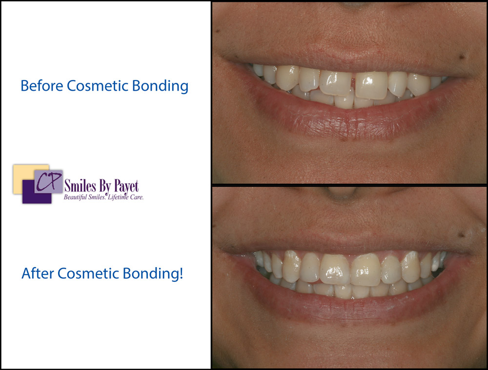 Charlotte dentist Dr. Payet used cosmetic tooth bonding to close a gap between front teeth.