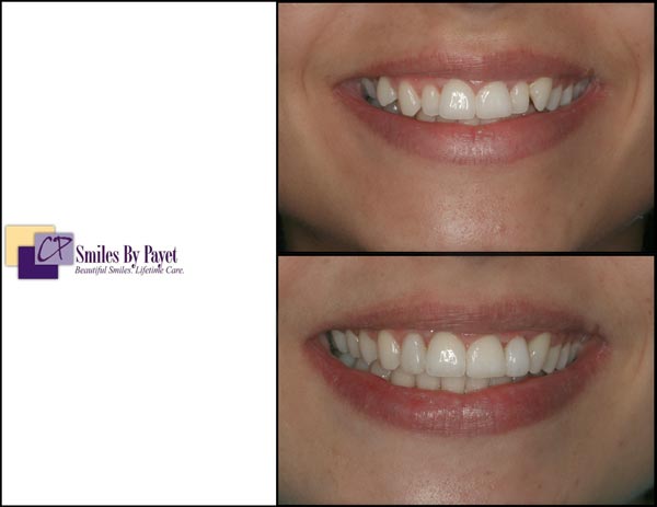 A beautiful, affordable kind of cosmetic dentistry with braces and bonding