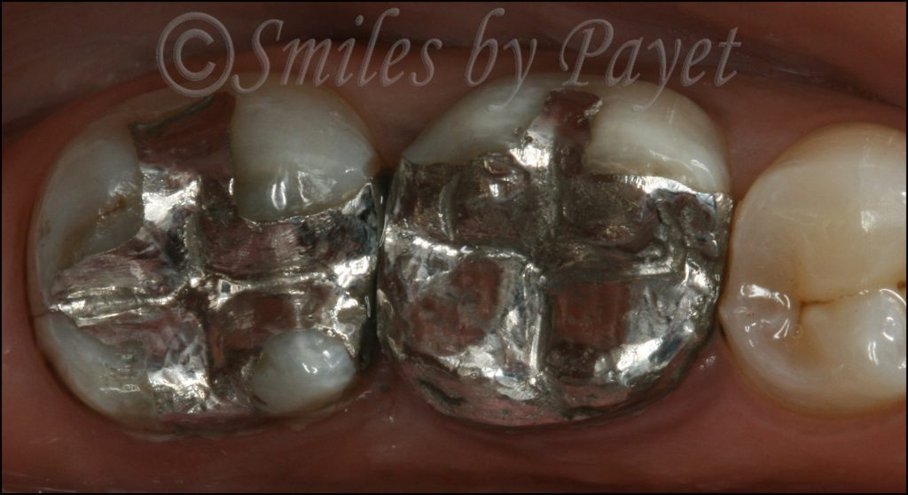 Dr. Payet talks about the safety of mercury silver fillings.