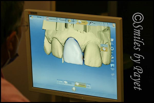 CEREC same-day porcelain crowns with digital imaging