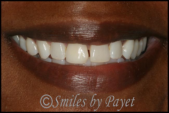 Before a new same-day porcelain crown and bonding with Charlotte dentist Dr. Payet