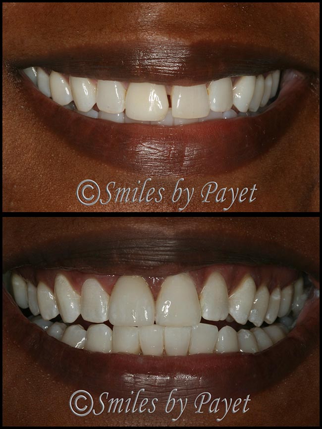 Cosmetic dentistry in Charlotte NC by Dr. Payet; porcelain crown and bonding