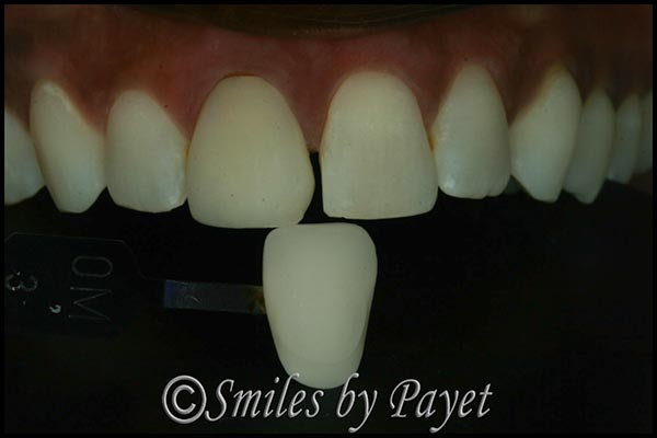 Charlotte cosmetic dentist Dr. Payet matches teeth and crowns
