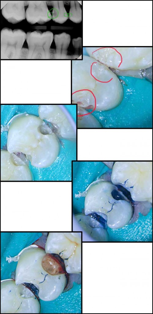 Cavities are usually bigger than they look.