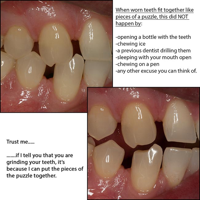 Dentists know if you're grinding your teeth, even if you don't think you do.