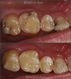 Tooth-colored fillings general dentistry