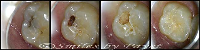 A tooth cavity can look small but actually be big