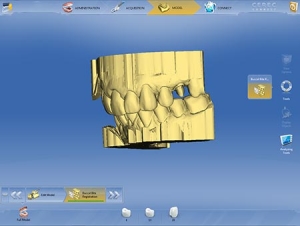 cerec-connect-digital-dentistry-charlotte