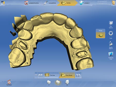 digital impressions of teeth