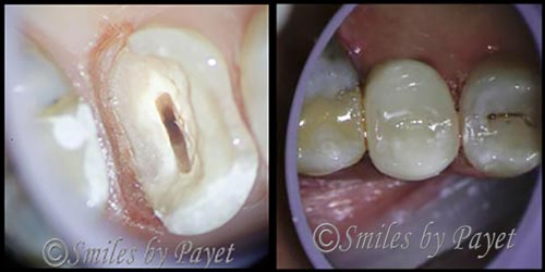 tooth that needs root canal