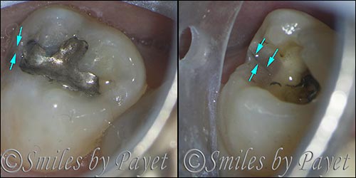 Some cracked teeth are ok with just fillings