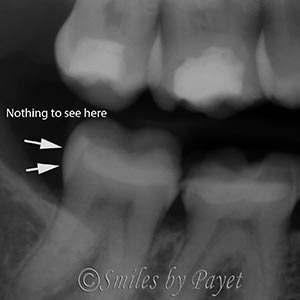 tooth cracks don't show up on x-rays Charlotte dentist