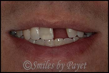 invisalign-then-dental-implant