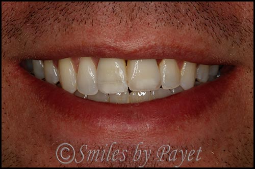 Invisalign and a dental implant and crown cosmetic dentistry