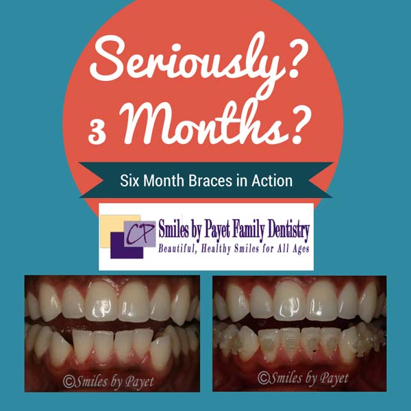 Charlotte dentist shows how fast Six Month Braces work