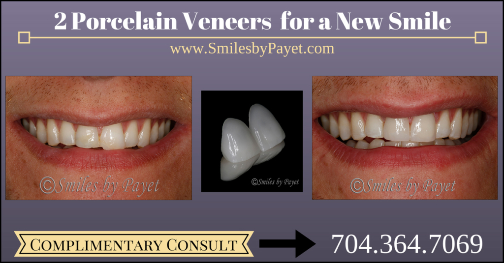 2 Porcelain Veneers by cosmetic dentist of Charlotte Dr. Payet