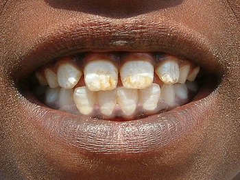 what does fluorosis look like, and is it bad