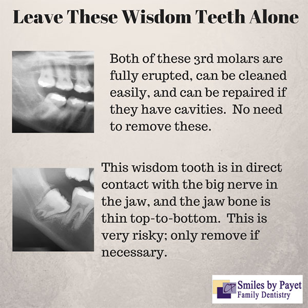 Examples of wisdom teeth that don't need to be taken out