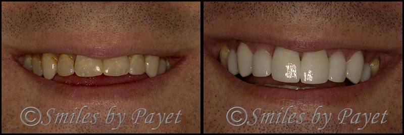 Cosmetic dentist of Charlotte NC, Dr. Payet, shows his own porcelain dental veneers