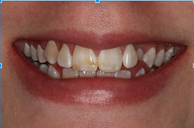 example of tooth fluorosis from a Charlotte dentist